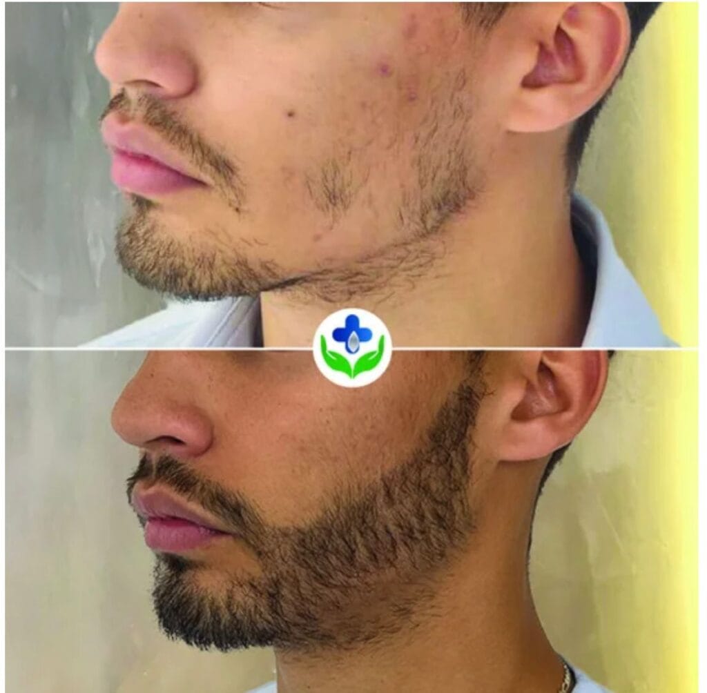 Resultado trasplante de barba antes y después - injerto barba Santiago Chile